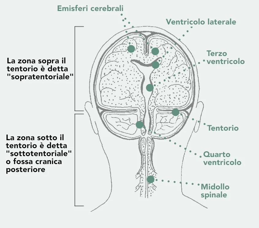 Sezione della testa vista da dietro con gli emisferi cerebrali, i ventricoli, il tentorio e il midollo spinale. Sopra il tentorio la zona sopratentoriale, sotto la zona sottotentoriale o fossa cranica posteriore.
